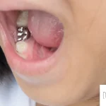 銀 歯 セラミック どっち
