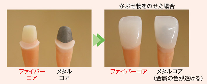 被せ物をのせた場合の見え方