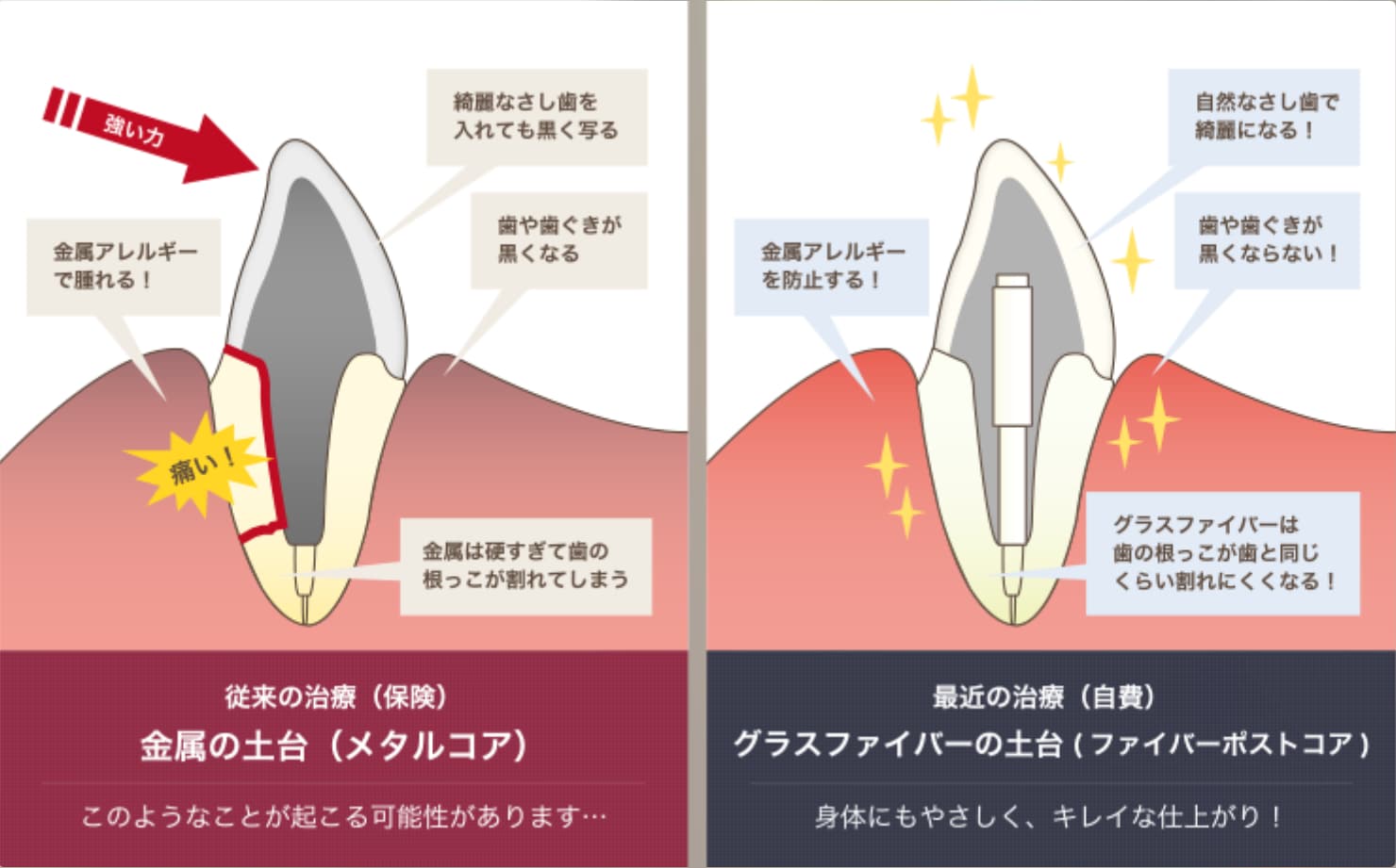 メタルコアとファイバーコアの仕組みとリスク比較