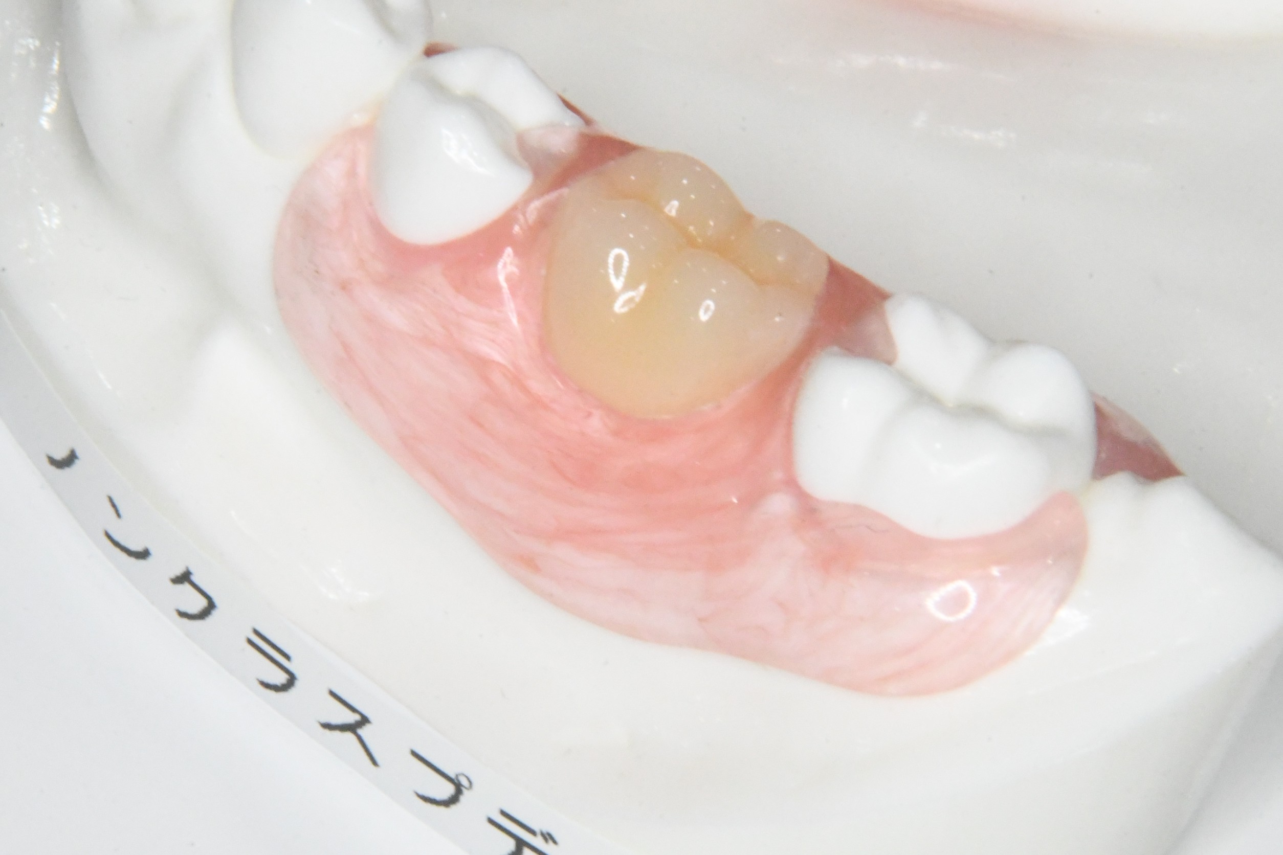 ノンクラスプデンチャーの症例写真2