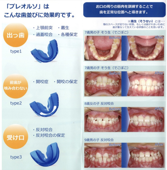 プレオルソはこんな歯並びに効果的です。出っ歯・前歯が噛み合わない・受け口