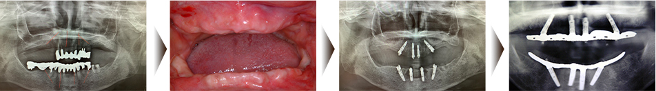 既存の歯を全て抜歯し、上下額４本ずつインプラントを埋入します