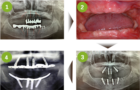 既存の歯を全て抜歯し、上下額４本ずつインプラントを埋入します