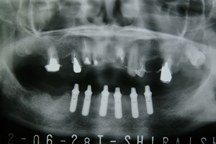 インプラント6本埋込時レントゲン