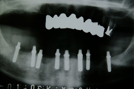 インプラント埋込時レントゲン